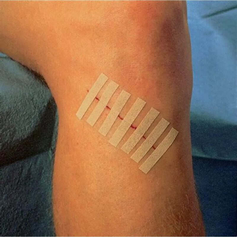 169d2d49395c861828c60fda48cb1abb 1 Ponto Falso Adesivo de Sutura SkinStrip - Skinupper